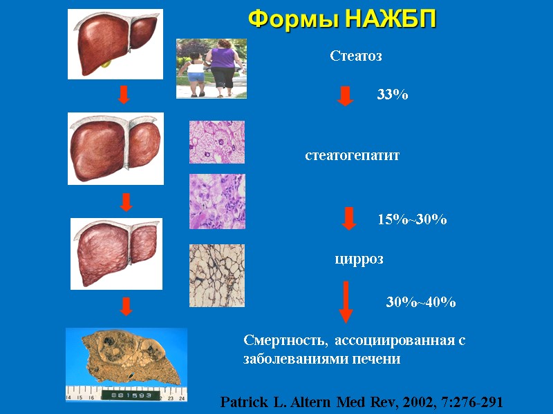 Стеатоз стеатогепатит  цирроз          